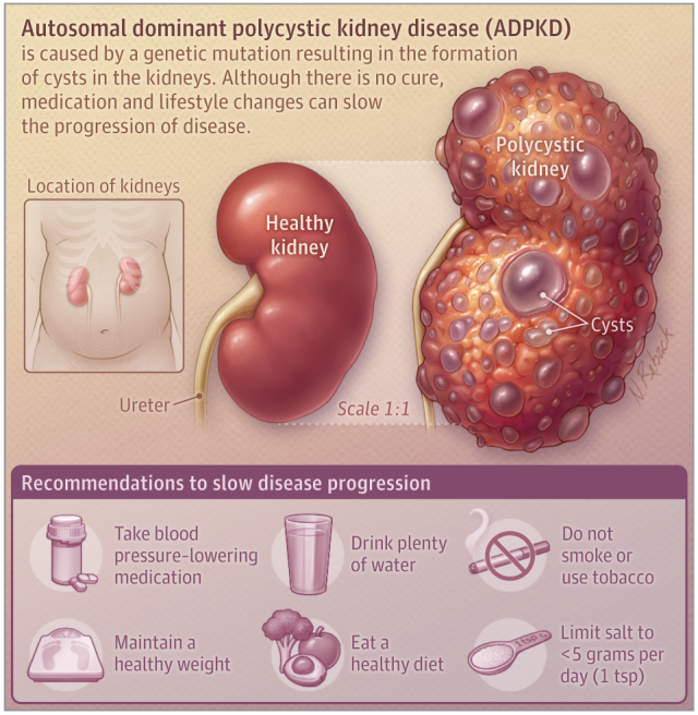 polykystose rénale autosomique dominante